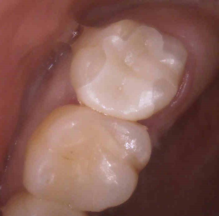 30代女性 奥歯の虫歯を白い歯詰め物で長持ちさせたい ジルコニアで治した症例 駒込の歯医者なら きたはら駒込歯科 Jr駒込駅徒歩1分