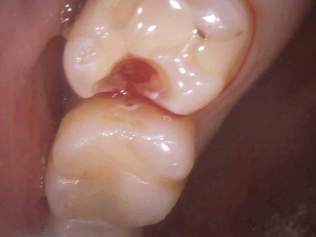 30代女性 奥歯の虫歯を白い歯詰め物で長持ちさせたい ジルコニアで治した症例 駒込の歯医者なら きたはら駒込歯科 Jr駒込駅徒歩1分